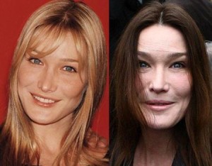 Carla Bruni Plastic Surgery: Miscalculated Cosmetic Procedures