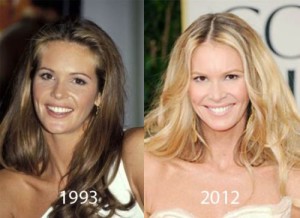 Elle Macpherson Plastic Surgery: Successful Beauty Enhancement