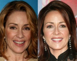 Patricia Heaton Plastic Surgery: A Well Orchestrated Surgical Operation
