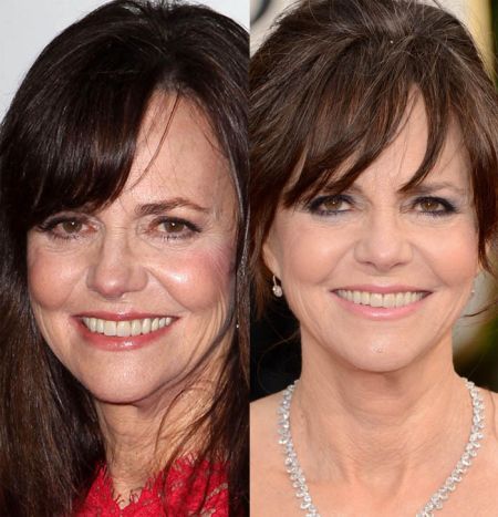 Sally Field plastic surgery before after
