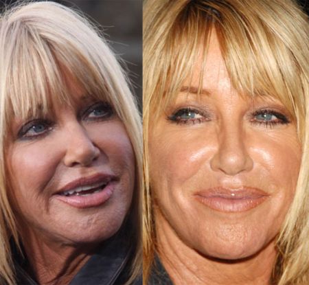 Suzanne Somers plastic surgery before and after