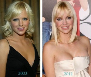 Anna Faris Plastic Surgery – Better and Comfortable looks