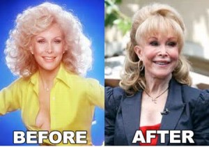 Barbara Eden Plastic Surgery – Reinventing a Youthful Look