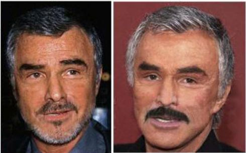 Burt Reynolds plastic surgery before and after