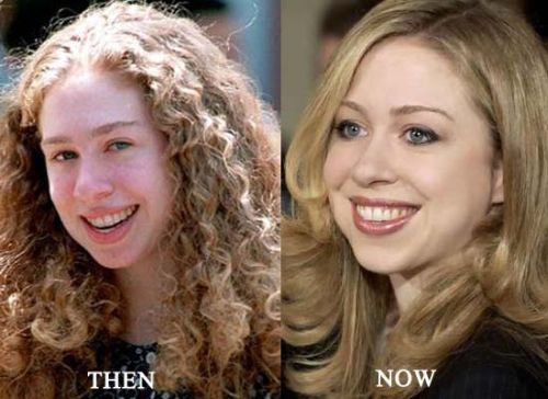 Chelsea Clinton plastic surgery before after