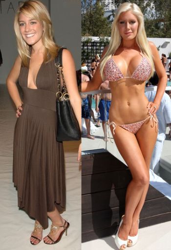 Heidi Montag plastic surgery before after