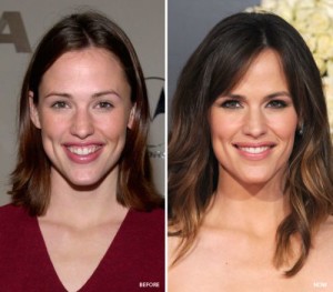 Jennifer Garner Plastic Surgery – A Gorgeous and Natural Look