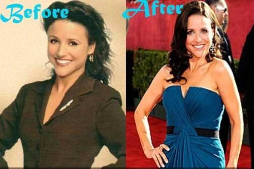 Julia Louis Dreyfus plastic surgery before and after
