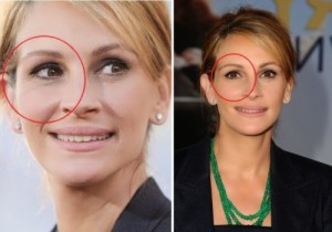 Julia Roberts Plastic Surgery Was Executed Well