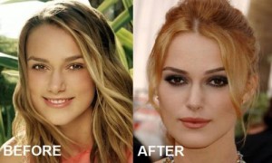 Keira Knightley Plastic Surgery Changed Her Looks Completely