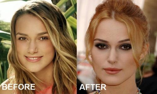 Keira Knightley plastic surgery before after