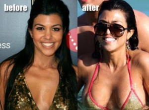 Kourtney Kardashian Plastic Surgery Before and After