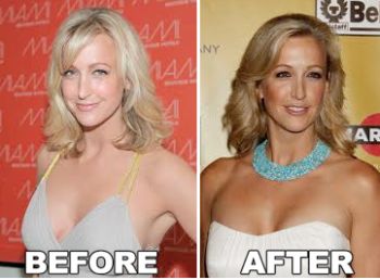 Lara Spencer plastic surgery before & after