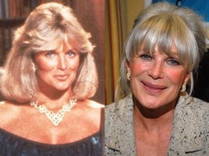 Linda Evans Plastic Surgery Was Overdone