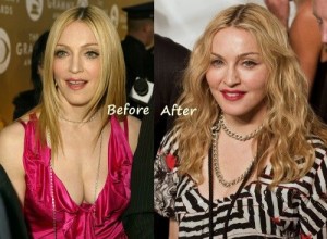 Madonna Plastic Surgery – An Amazing Look