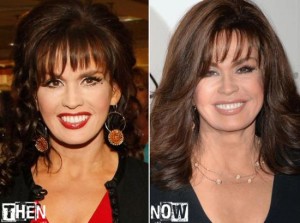 Marie Osmond Plastic Surgery – Reinventing a Glamorous Look