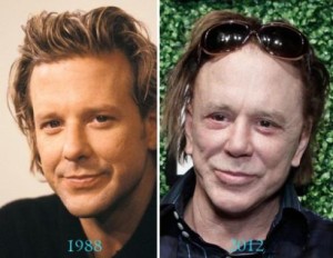 Mickey Rourke Plastic Surgery Gone Wrong – Before and After Photos