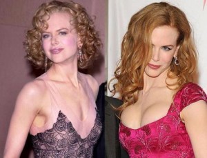 Nicole Kidman Plastic Surgery – Sub-Standard Work