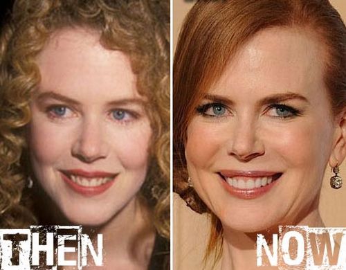 Nicole Kidman plastic surgery before after