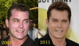 Ray Liotta Plastic Surgery – A Failed Surgery