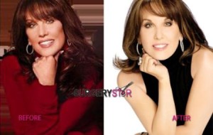 Robin Mcgraw Plastic Surgery – A Youthful Look