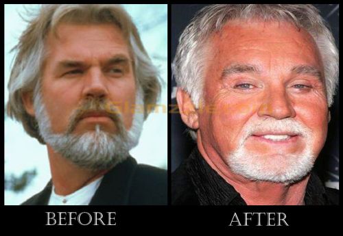 Kenny Rogers plastic surgery before and after