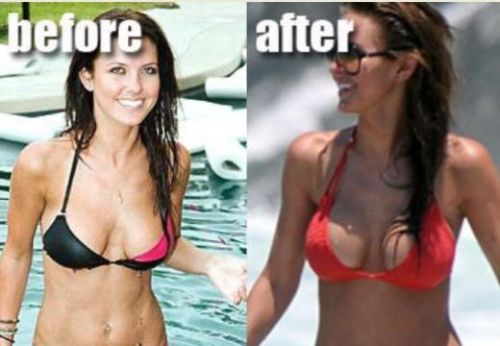 Audrina Patridge Plastic Surgery Before and After