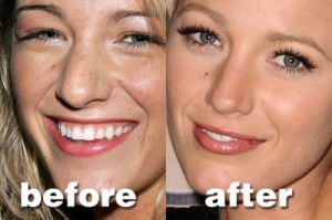 Blake Lively Plastic Surgery: A Great Cosmetic Procedure
