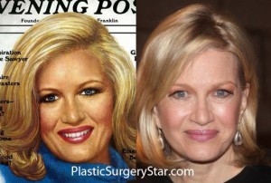 Diane Sawyer Plastic Surgery – A Game Played Wisely