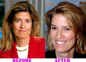 Greta Van Susteren Plastic Surgery – Before & After Photos