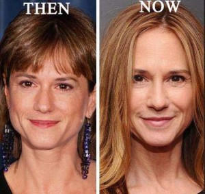 Holly Hunter Plastic Surgery – A Timely Procedure For Her Age