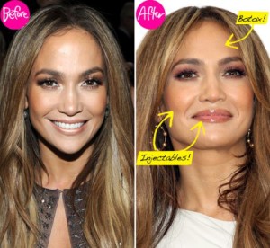 Jennifer Lopez Plastic Surgery – Lip Fillers & Botox
