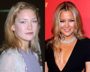 Kate Hudson Plastic Surgery Gone Wrong – Before & After Photos