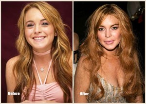 Lindsay Lohan Plastic Surgery – A Minimal Lip Job Done Well