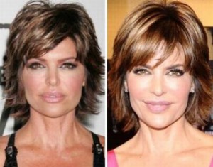 Lisa Rinna Plastic Surgery: A Self-Confessed Mishap