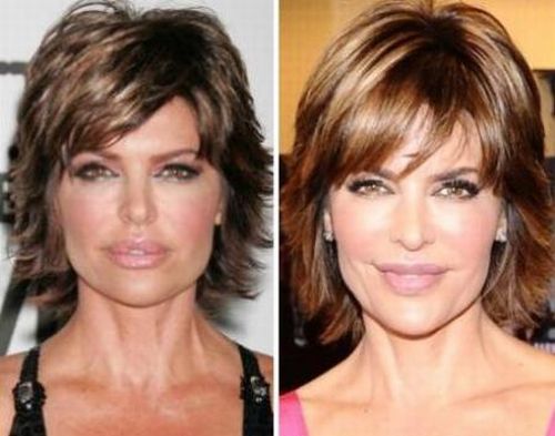 Lisa Rinna plastic surgery before after