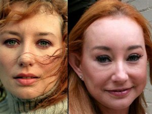 Tori Amos Plastic Surgery Disaster – Before & After Photos