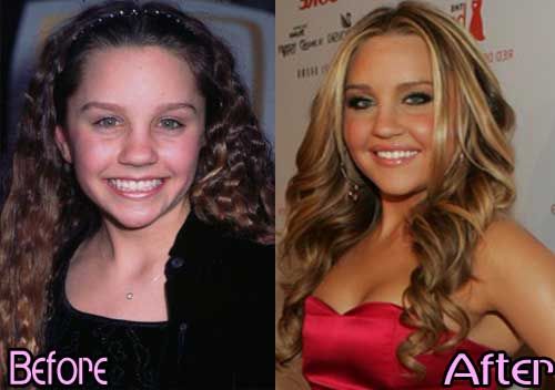 Amanda Bynes nose job before and after