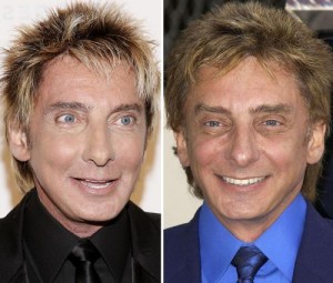 Barry Manilow Plastic Surgery – Fail or Win?
