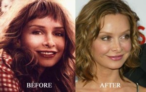 Calista Flockhart Plastic Surgery: True or Just Allegations?