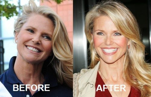 Christie Brinkley plastic surgery before and after