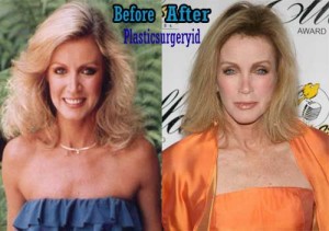 Donna Mills Before and After Plastic Surgery Photos