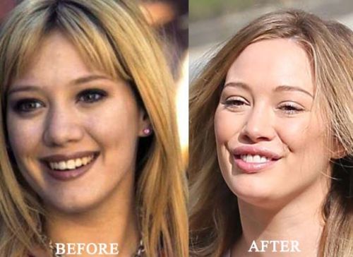 Hilary Duff plastic surgery before and after