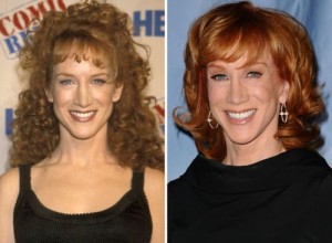 Kathy Griffin Plastic Surgery – A Befitting Procedure for Her Age