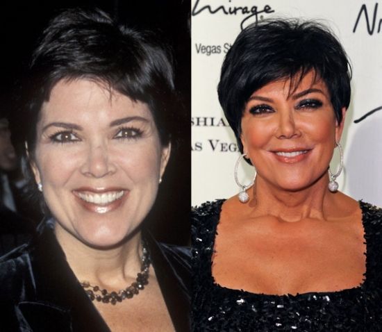 Kris Jenner plastic surgery before and after