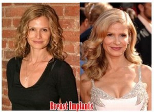 Kyra Sedgwick Plastic Surgery Was a Success