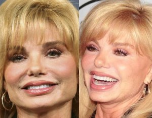 Did Loni Anderson Have Plastic Surgery: Before and After Photos