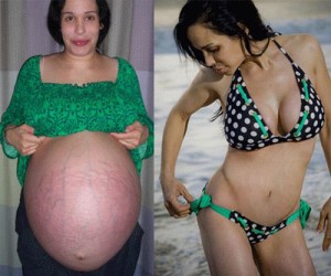 Nadya Suleman Plastic Surgery Dismay