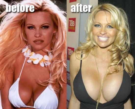 Pamela Anderson breast implants before and after