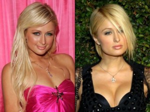 Paris Hilton Plastic Surgery Did Not Go Her Way